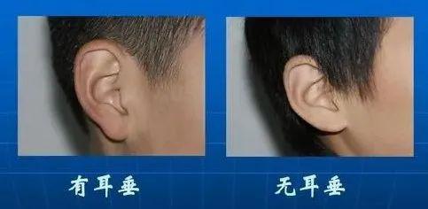 有耳垂和没耳垂哪个好
