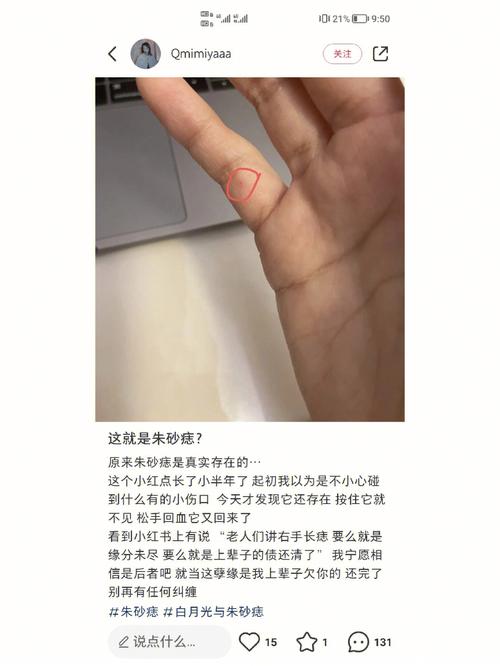 为什么手上会长朱砂痣,手心有痣心思缜密的人