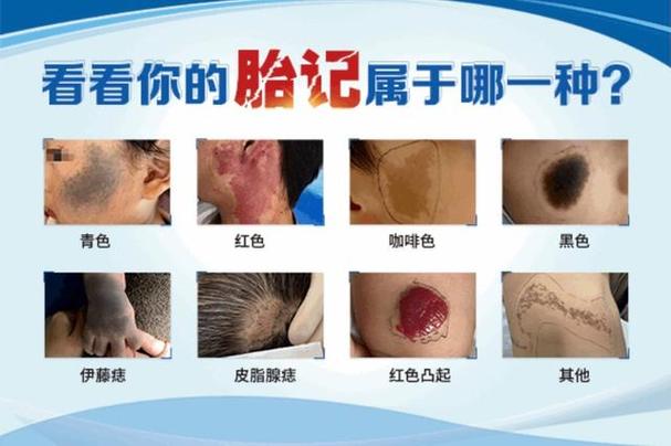 脸上胎记的位置与命运,嘴角有胎记的说法
