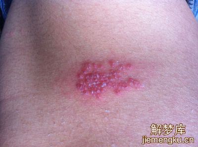 梦见脓疱是什么意思