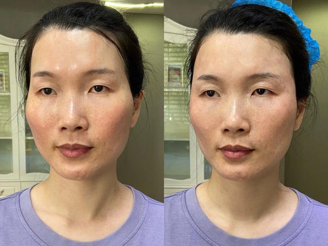 太阳穴凹陷,夫妻关系不好