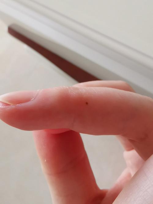 女生左手中指长了一颗痣有什么含义吗