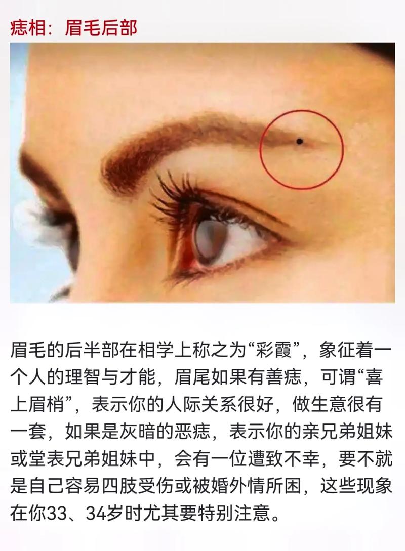 痣能随便去掉吗