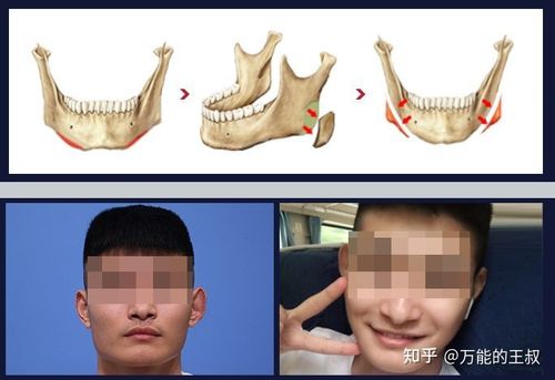 下颌骨肥大好不好