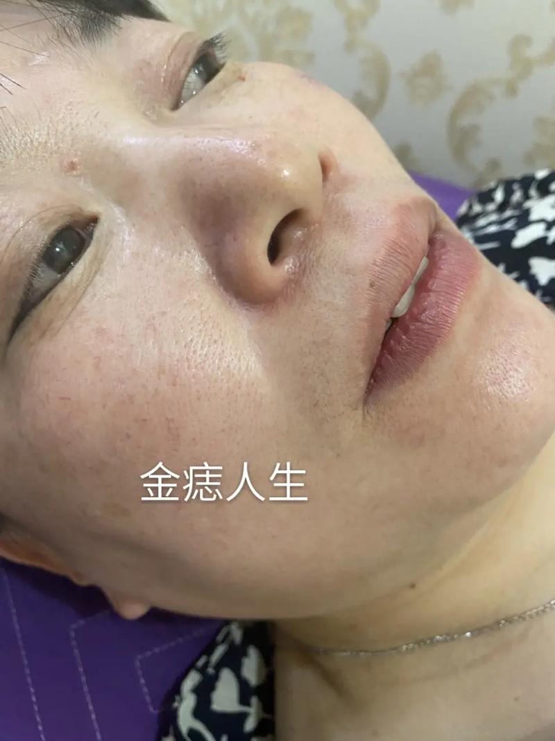 嘴角有痣代表什么