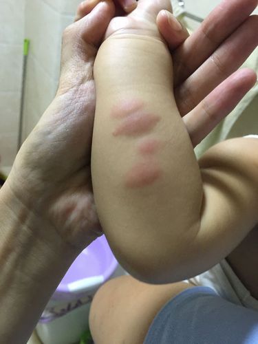 梦到被蚊子咬了好多包是什么意思