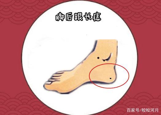 脚缝长痣是好运的象征吗