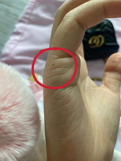 手上长痣是怎么回事
