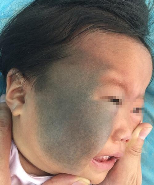 脸上有胎记的人命运如何