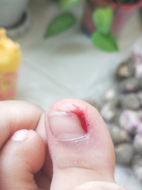 梦到脚被扎破流血是什么意思