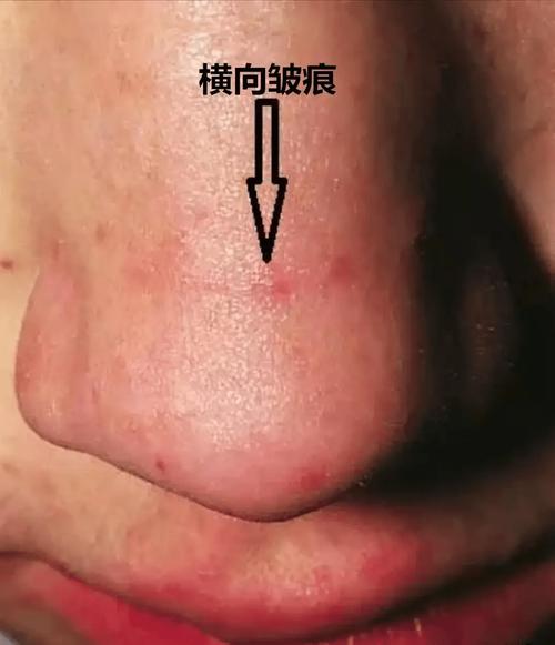 鼻梁皱褶多是女人穷困的象征吗