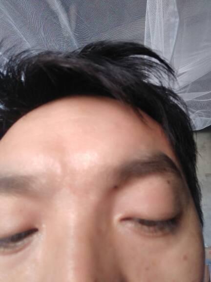 印堂有疤痕代表什么