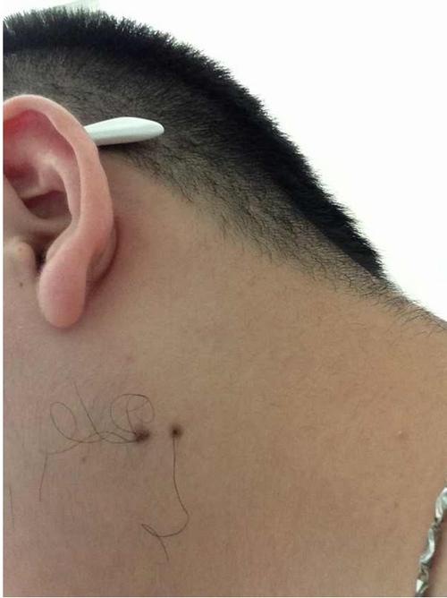脖子痣上长毛代表什么