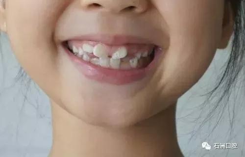 门牙有缝对一个人的命运有什么影响?