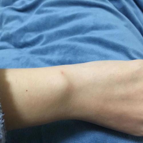 手臂上长红痣好还是黑痣好?有什么含义吗?