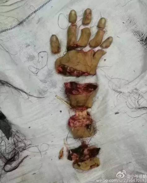 梦见被牛咬断手