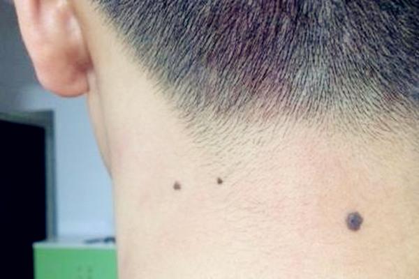 男人脖子左侧边长痣
