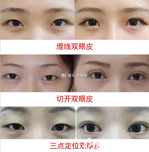 割双眼皮影响婚姻财运