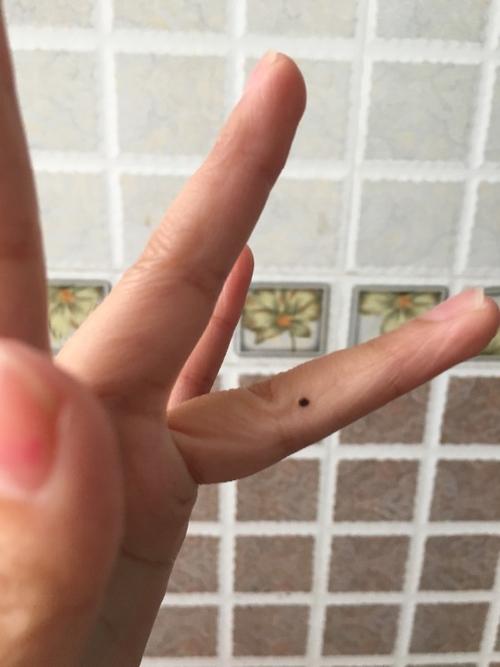 女右手无名指侧面长痣