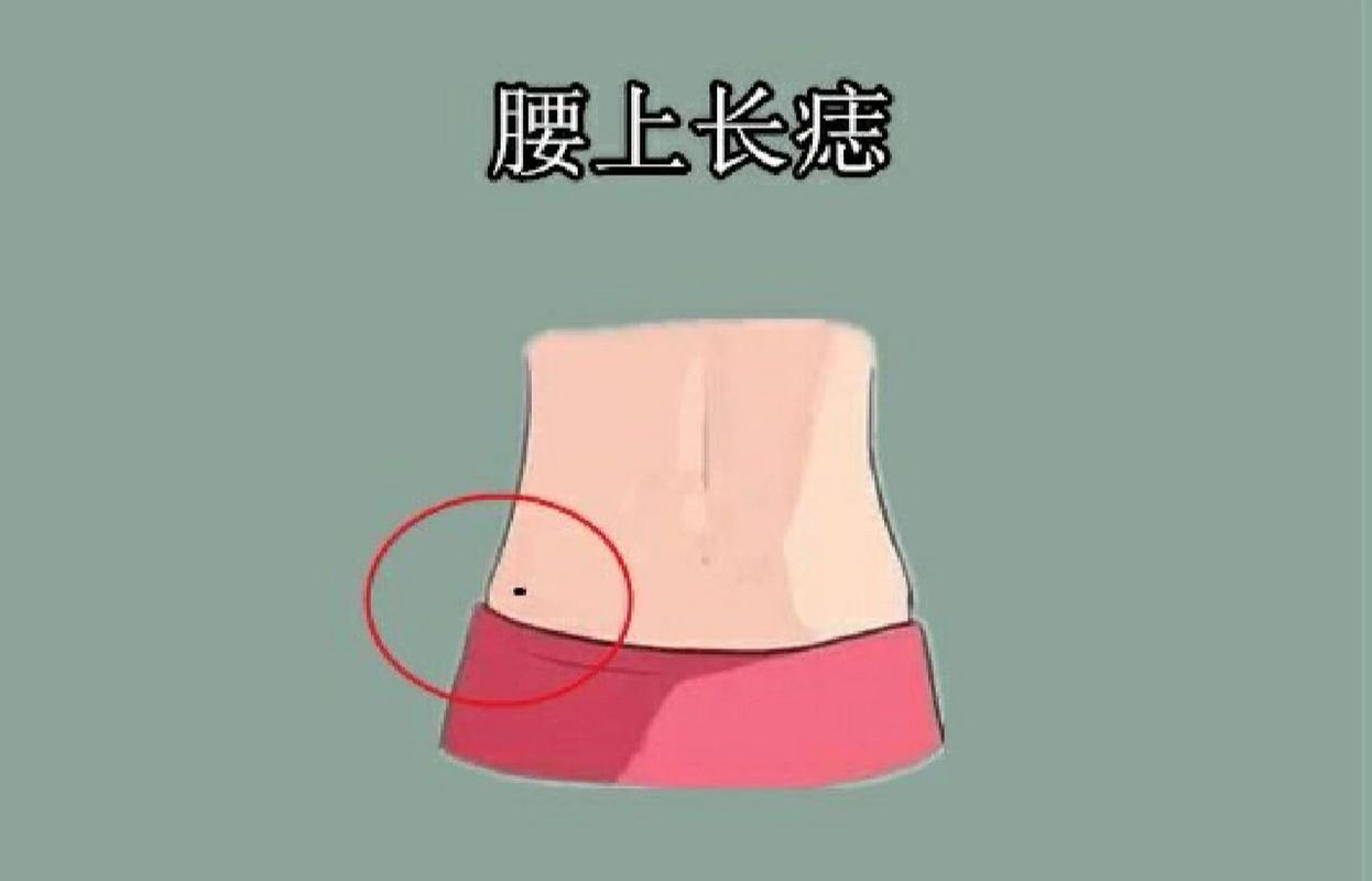 女人右腰上有痣代表什么意思