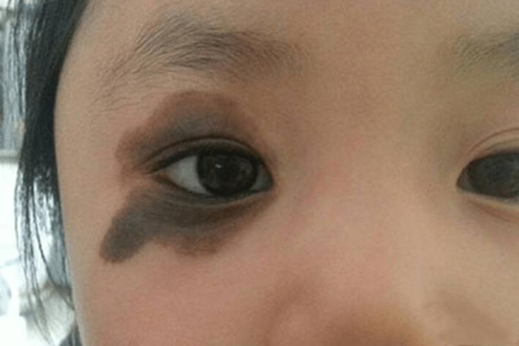 胎记看健康 胎记看健康医典