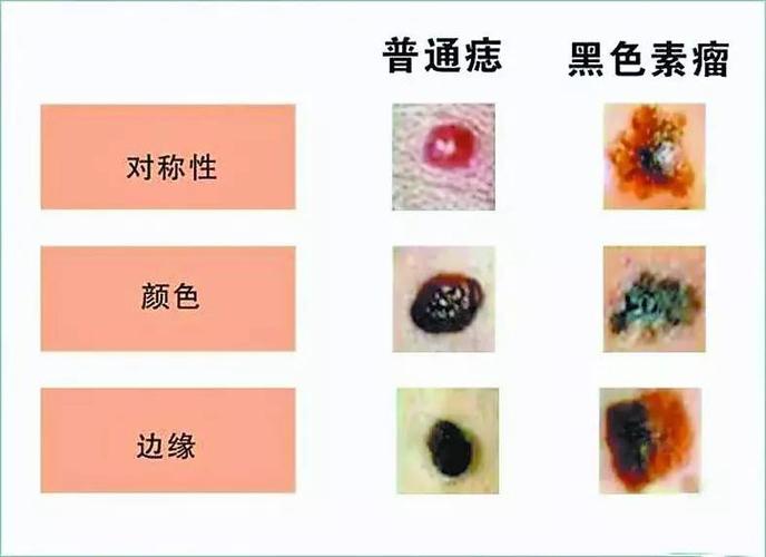 注意!这4种痣,可能有癌症的趋向!用一套法则自测,及时发现