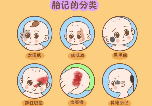 胎记的位置与命运的关系