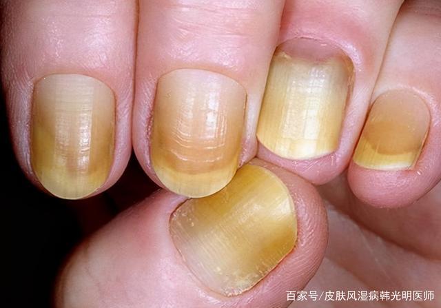 指甲较宽大的话,代表身体健康吗?