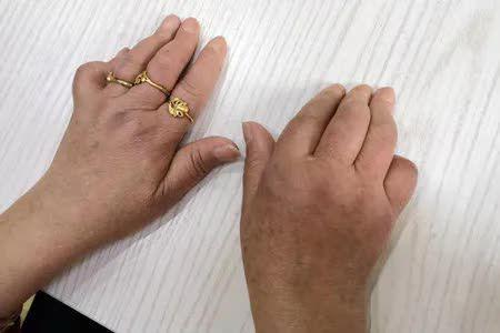 手指关节大的人比关节小的人生活辛苦