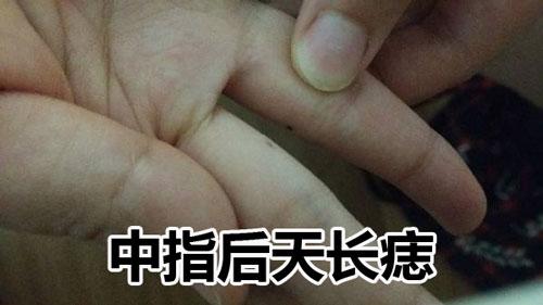 右手中指上突然长痣代表什么
