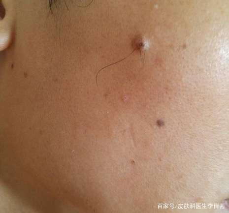 长毛的痣好吗?