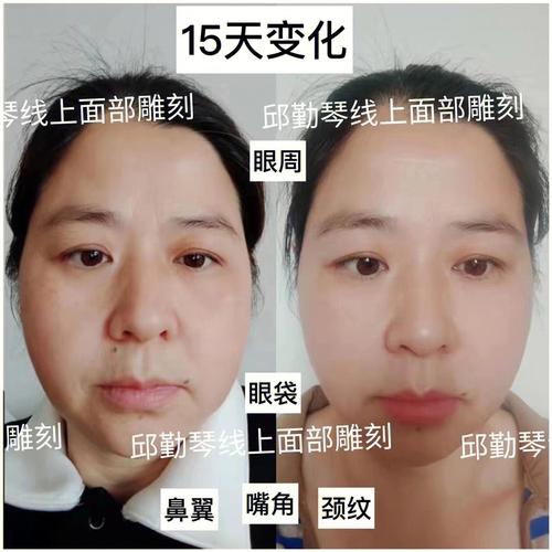 抬头纹有痣好吗