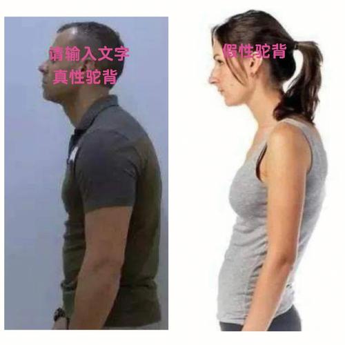 人驼背和龟背区别图解