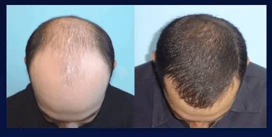 梦见秃子长出了头发