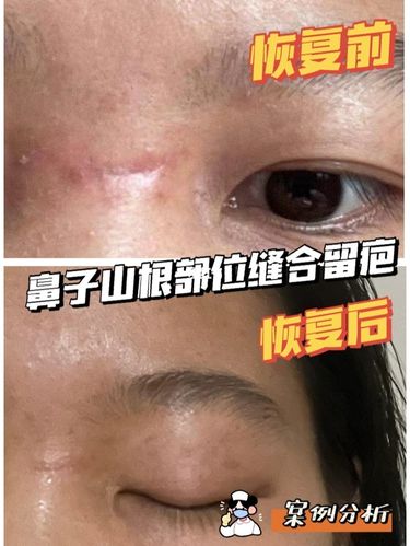 山根有疤痕的人财运怎么样