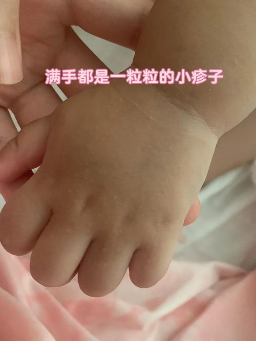 梦见皮疹怎么回事