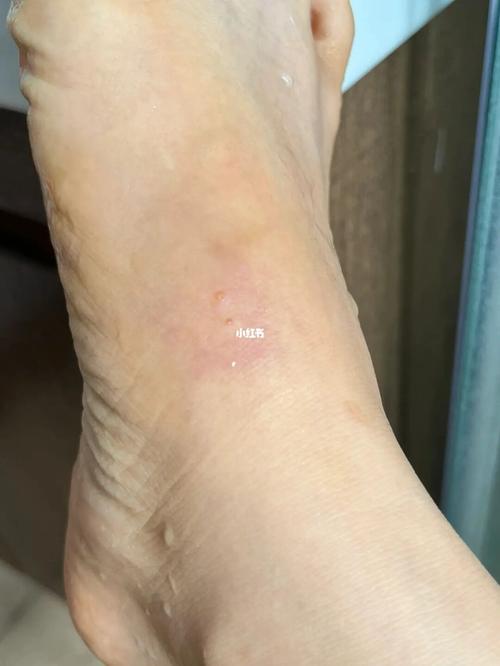 梦见黑蚂蚁咬到脚