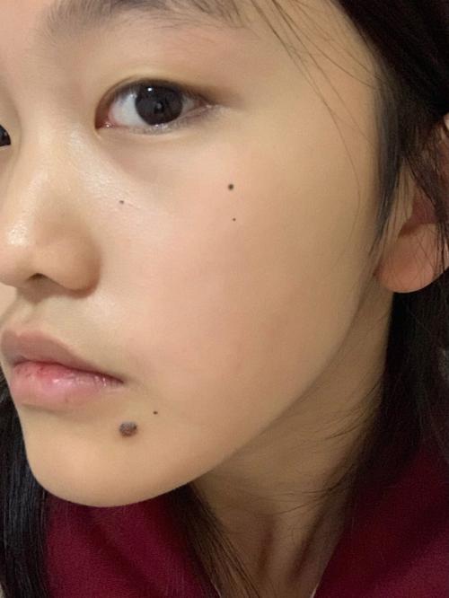 脸上什么地方的痣可以取