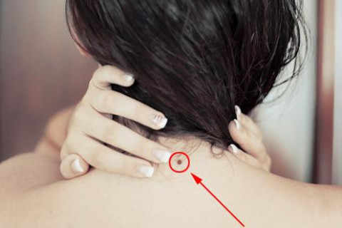 后脖有痣的女人怎么样