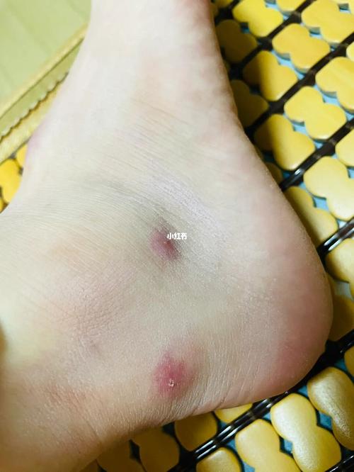 梦见踩到很多蚂蚁被咬