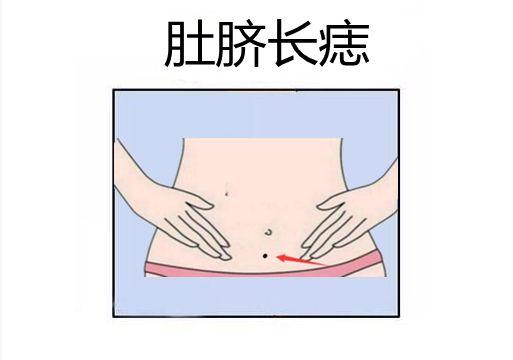 肚脐眼长痣的人既旺夫又益子是真的吗?