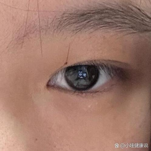 相双眼皮上长了一颗肉痣