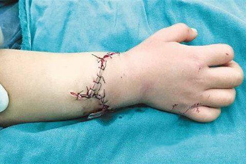 梦见手腕开刀