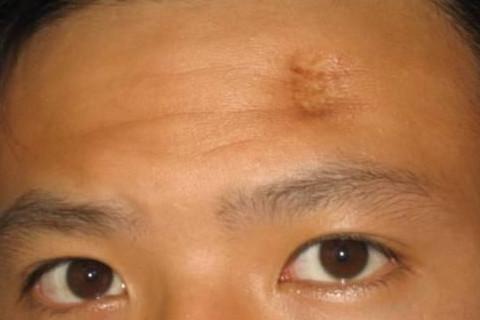 印堂有疤的男人面相