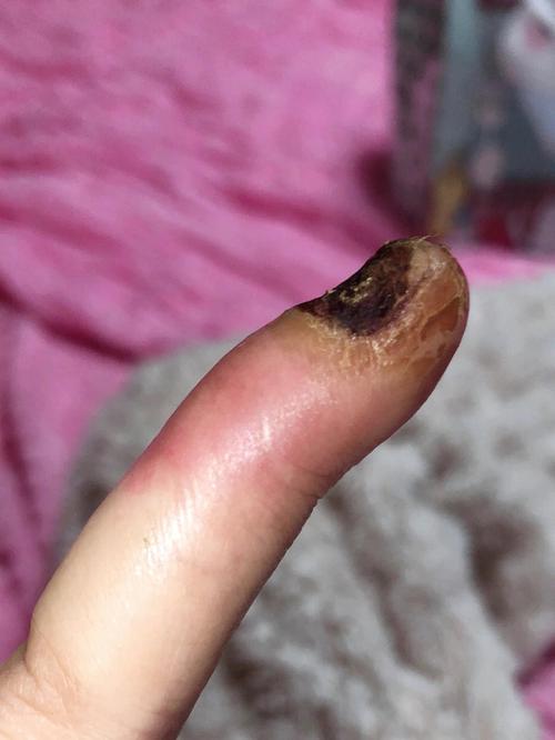 梦见整个指甲脱落不疼什么意思