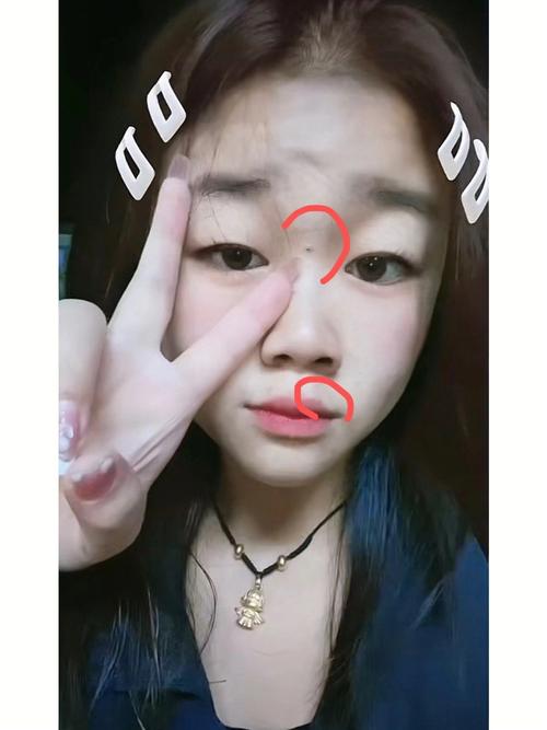 脸上的痣可以去掉吗