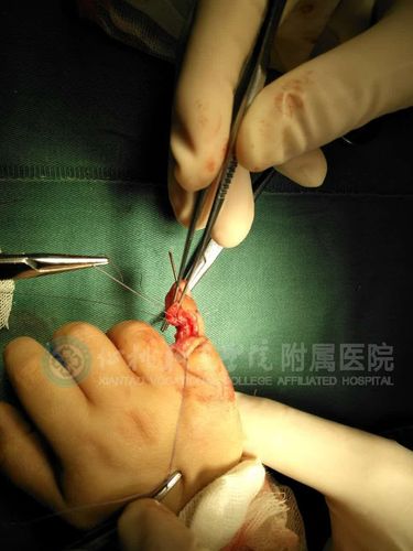 梦见爸爸切掉右小指