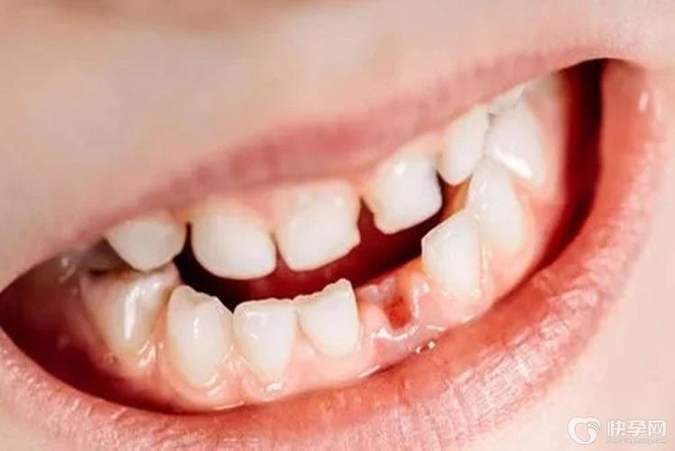 孕妇梦见牙掉了一颗