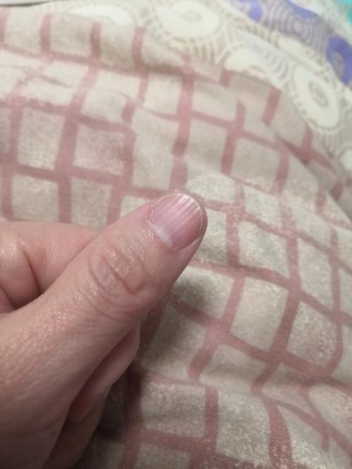 指甲上有竖纹是怎么回事