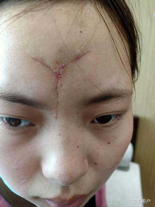 脸上有疤的女人命好吗,女人脸上有疤的说法